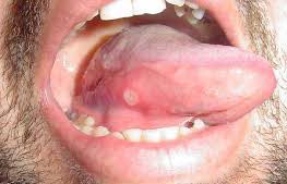 canker sores