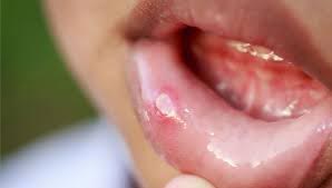 A canker sore on the lower lip